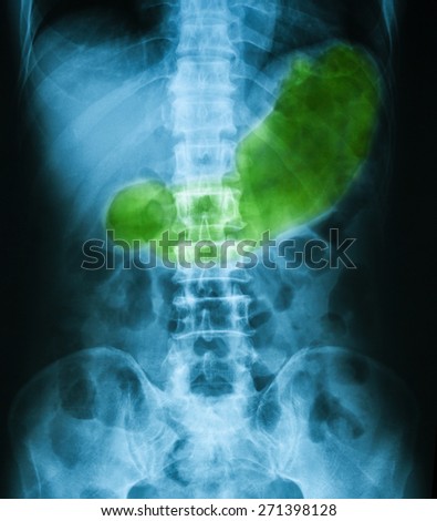 X-ray image of Abdomen supine position, show gastric juice and stomach or gastric ulcer.