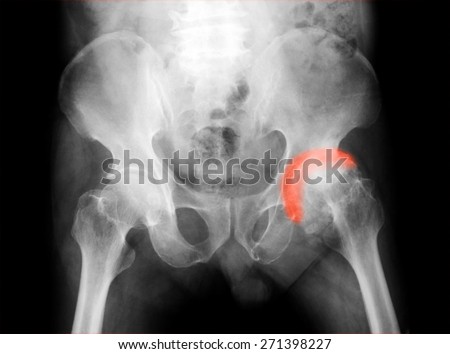 X-ray pelvis with both hip joints , AP view, show left hip osteoarthritis (Degenerative arthritis of the hip)