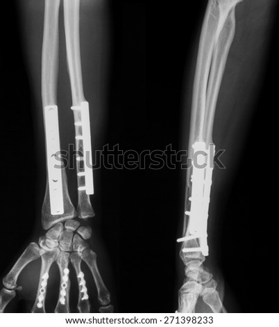 X-ray image of ulnar and radius fracture, AP and lateral view, after operated and internal fixed by plate and screw.