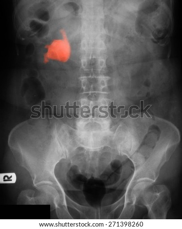 X- ray image of plain KUB (Kidney, Ureter, Bladder ), Show right kidney stone.