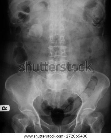 X-ray image of plain KUB (kidney, ureter and bladder), show right kidney stone.