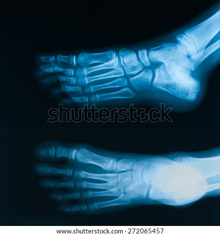 X-ray image of  foot  AP and oblique view, show toe and calcaneus fracture.