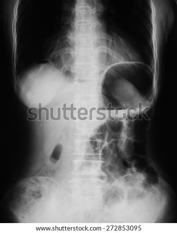 X-ray image of plain abdomen upright.
