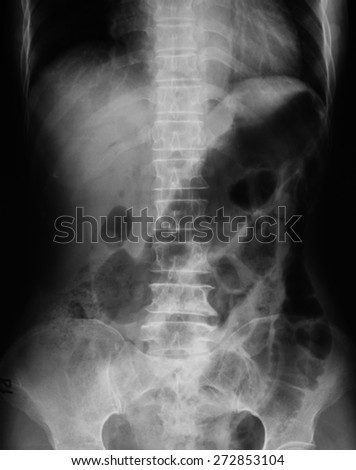 X-ray image of plain abdomen supine.