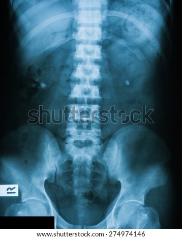 X-ray image of plain KUB (kidney, ureter, bladder), show  kidney stones.