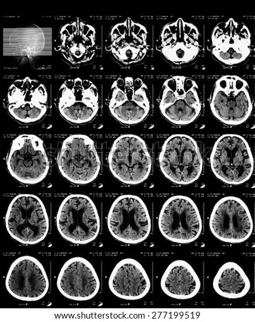 CT scan of brain without contrast media.