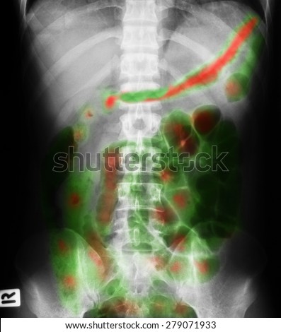 X-ray image of plain abdomen, Showing gastroenterocolitis.