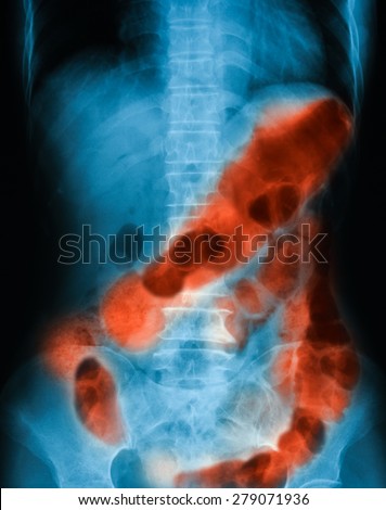 X-ray image of plain abdomen, Show gastrointestinal bleeding or GI bleeding.