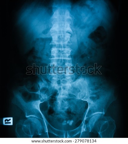 X-ray image of plain KUB, show bladder stones.