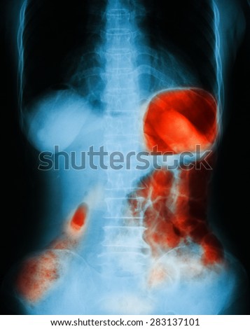 X-ray image of abdomen pain, upright view. Shows gastrointestinal bleeding or GI bleeding