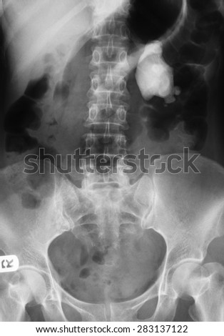 X-ray image of Plan KUB, Shows left kidney stone.