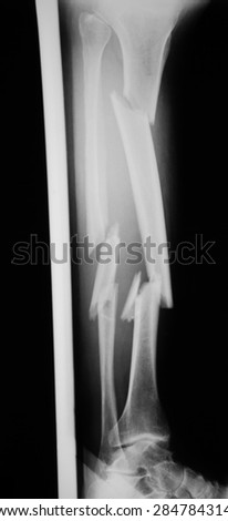 X-ray image of broken lag with plast wood splint