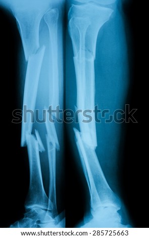 X-ray image of broken leg, AP and lateral view.Showing tibia and fibula fractures.