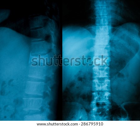 X-ray image of lumbar spine, AP and lateral view, Shows compression fracture of the first lumbar Spine.