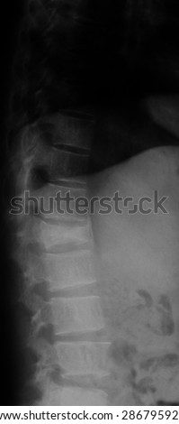 X-ray image of lumbar spine, lateral view, Shows compression fracture of the first lumbar Spine