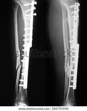 X-ray image of tibia and fibula fractures, 5 months and 2 years after has been treated with plates and screws