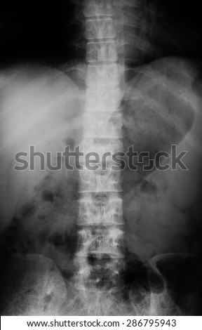 X-ray image of lumbar spine, AP view, Shows compression fracture of the first lumbar Spine,