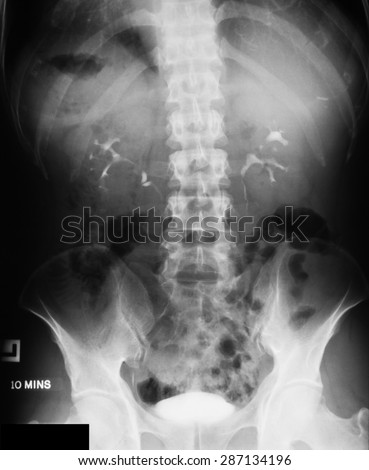 X-ray image of Intravenous Pyelogram (IVP), 10 minutes post injection of contrast media, prone position.