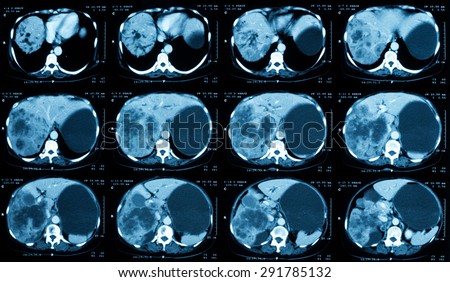 CT scan of upper abdomen with contrast media, clinical case of gallbladder cancer.