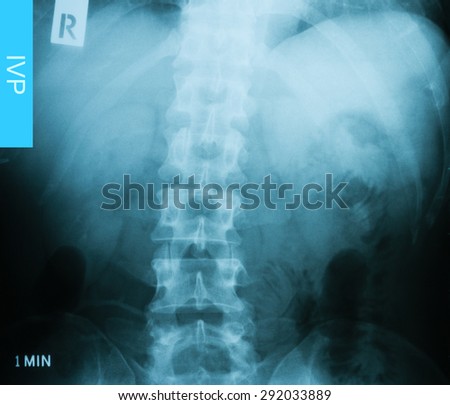 X-ray image of Intravenous pyelogram (IVP), 1 minute post injection of contrast media.