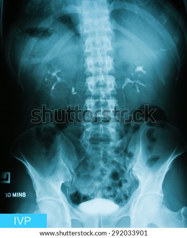 X-ray image of Intravenous pyelogram (IVP),10 minutes post injection of contrast media.