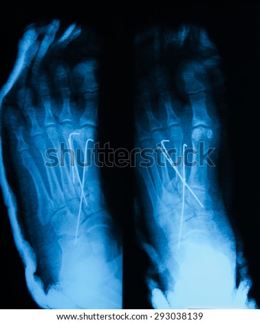 X-ray image of metatarsal fracture, AP and oblique view, after surgery and fixed by pins.