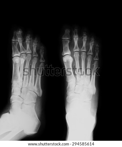 X-ray image of foot, AP and oblique view, Shows the second metatarsal fracture,