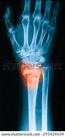 X-ray image of wrist joint posteroanterior (PA) view, shows ulna fracture.