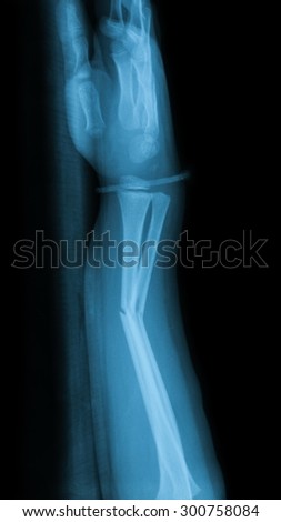 X-ray image of forearm and wooden splint, lateral view, shows ulna and radius fracture.