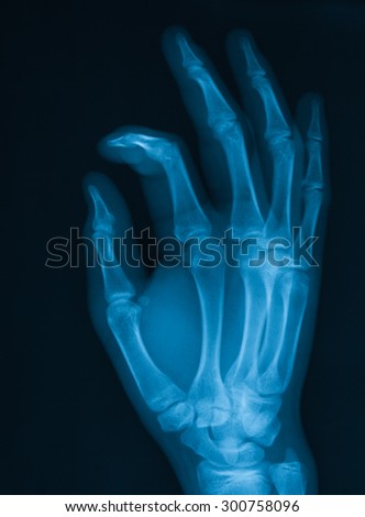 X-ray image of hand, oblique view, shows fracture of the proximal interphalangeal joint of the index fingers.