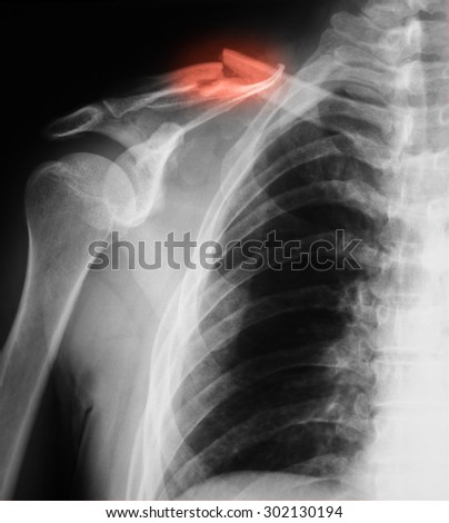 X-ray image of clavicle, AP view. showing clavicle fracture.