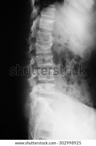 X-ray Image of Lumbar Spine or L-s Spine Lateral View for