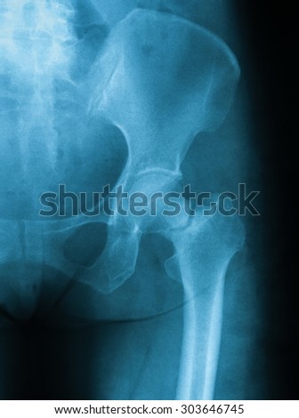X-ray image of hip joint, AP view. showing femoral neck fracture.