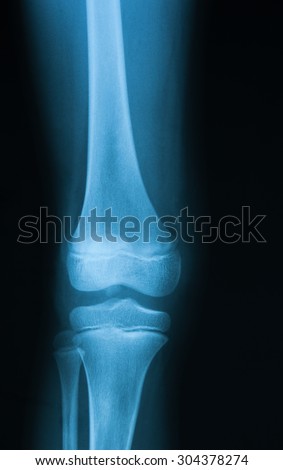 X-ray image of a normal knee joint anteroposterio view, young girl.