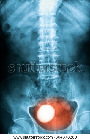 X-ray image of KUB (Kidney,Ureter and Bladder), supine view, Showing bladder stone