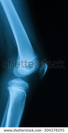 X-ray image of a normal knee lateral view, young girl.