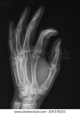 X-ray image of hand, PA view, Showing fracture of proximal phalanx of index finger.