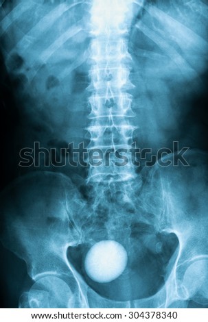 X-ray image of plan KUB (Kidney,Ureter and Bladder), supine view, Showing bladder stone