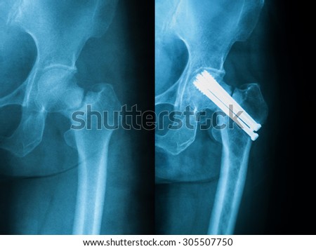 X-ray image of hip joint AP view, preoperative and postoperative, showing femoral neck fracture and hip compression screw.