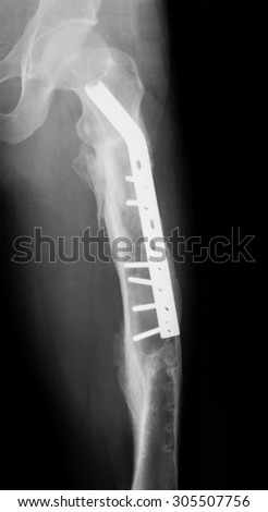 X-ray image of femur,AP view, showing femur fracture with compression plate an screws.