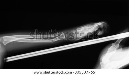 X-ray image of baby forearm and mother\'s hand holding wooden splint.