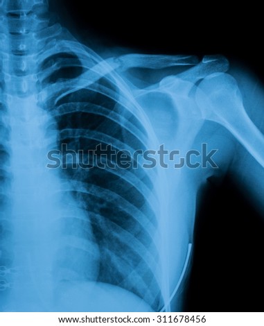 X-ray image of clavicle AP view, Showing clavicle fracture.