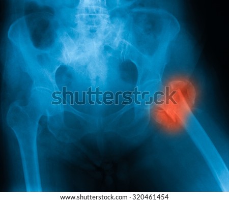 X-ray image of both hip showing femur fracture at left side.