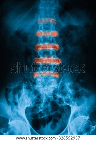 X-ray image of lumbar spine shows osteoarthritis of lumbar, AP view.