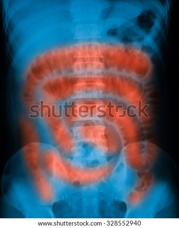 X-ray image of acute abdominal pain showing small bowel obstruction, supine view.
