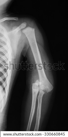 X-ray image of elbow showing fractures and dislocation of elbow, AP view.