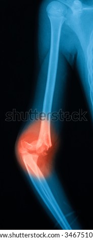X-ray image of elbow showing elbow fracture and dislocation.
