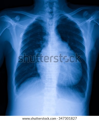 Digital X-ray image of Chest, AP view. Show heart disease.