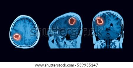 Magnetic resonance imaging (MRI) of the brain,  Intracerebral hemorrhage (ICH),\
brain abscess, three views (sagittal, coronal and transverse)