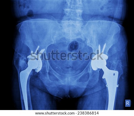 xray of hip replacement double